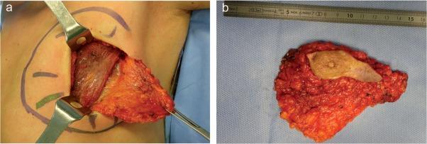 男性乳腺癌:是选择改良根治术还是保乳手术?