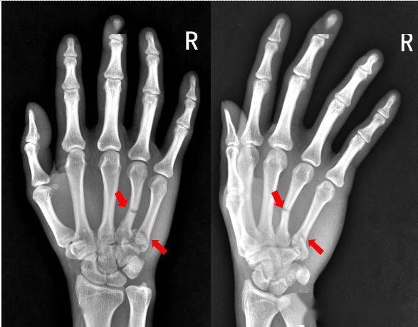 右手第五掌骨骨折(1-5.
