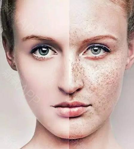 明星一脸斑却美翻天,可夏天到了,我要不要祛斑?