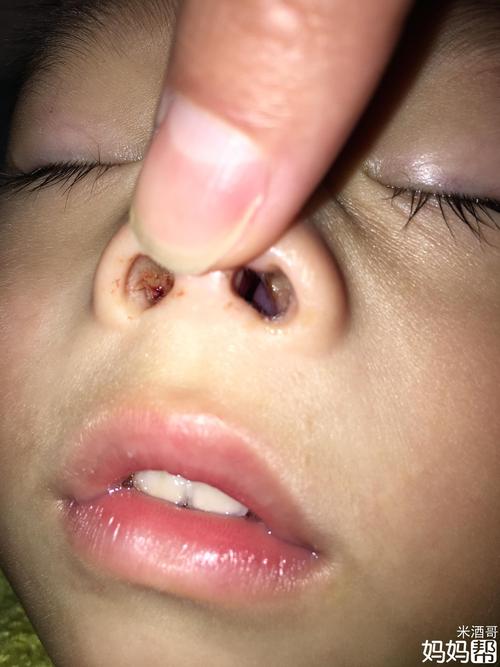 宝宝鼻子长东西了【吓】