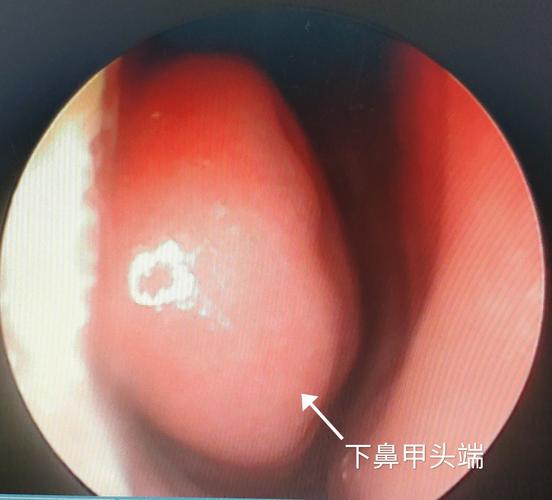 照镜子发现鼻子里有个红色肿物是什么?
