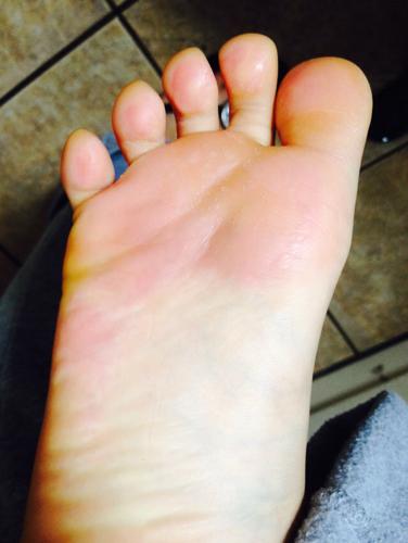 每天晚上回家脚掌脚发白,蜂窝眼,有臭味