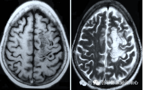 图文详解脱髓鞘脑病影像诊断