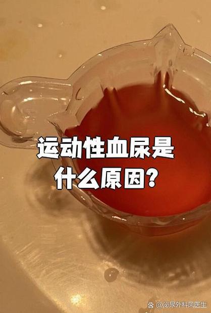 运动性血尿是指剧烈运动后突然出现的血尿,检查后找不到其他明确