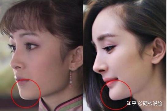 杨幂整容史分析