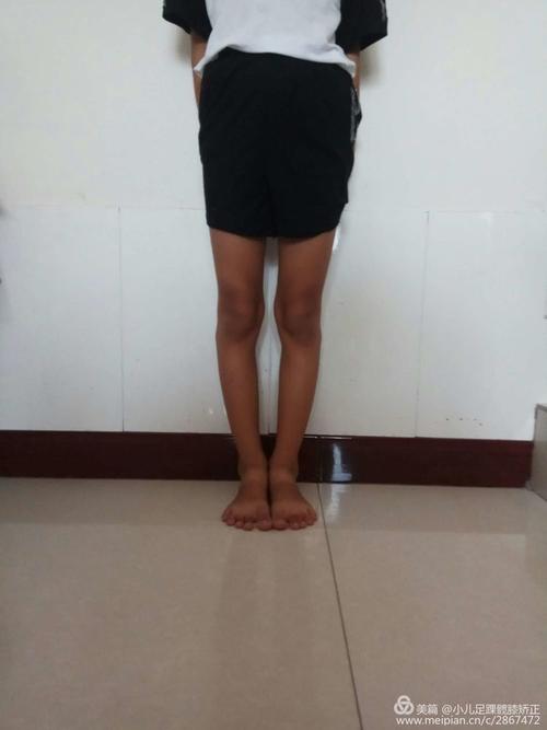 罗圈腿又名o型腿儿童比较常见家里有这样的孩子不必发愁了