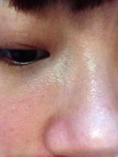 如图,脸上像鸡皮疙瘩这个东西是什么,怎么改善