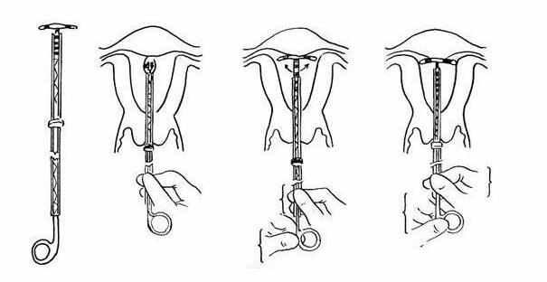 心疼老婆一万遍, 取节育环手术全过程