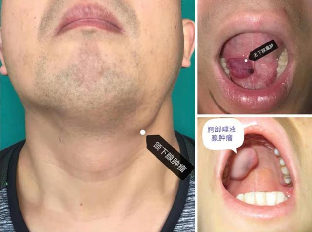耳垂下长肿物,原来是腮腺肿瘤
