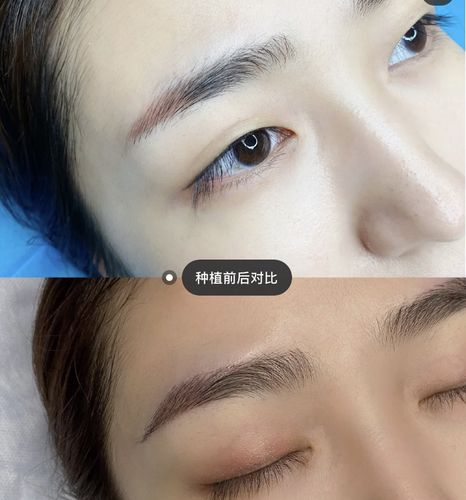 种植眉毛手术效果图