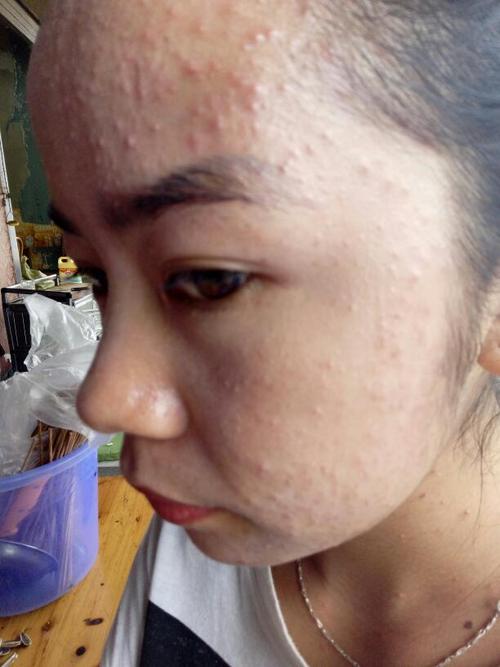 喝了胶原蛋白以后,脸上这样了,这是过敏还是排毒呢?