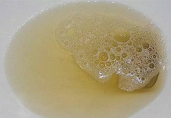 知识问答 社会知识  多数情况属正常尿液中有泡沫说明里面含有蛋白质.