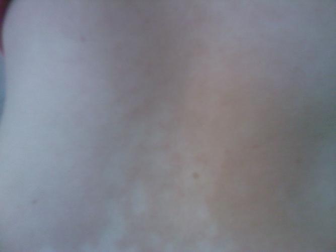 以前就知道自己酒精过敏,喝多了啤酒也就是起红点点,或是肿一片一片