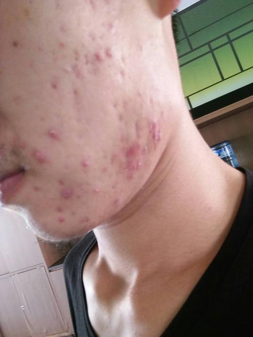 面部脸颊下额近俩月频繁长出好多这样的痘痘,谁知道这