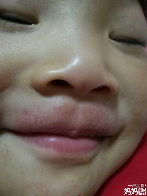 3岁宝宝突然嘴唇上一圈红的,求解?