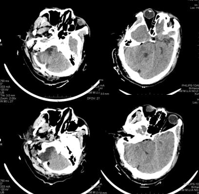 枕骨大孔脑膜瘤1例