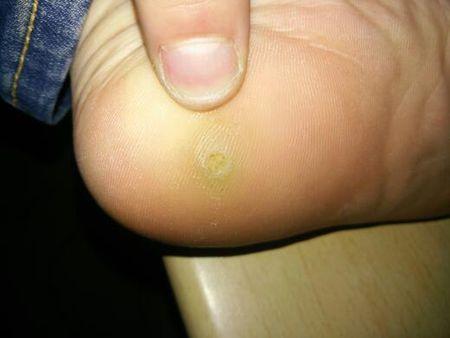 图上的长在脚上的那个黄色小坑是一个小肉豆,之前以为是鸡眼,所以用