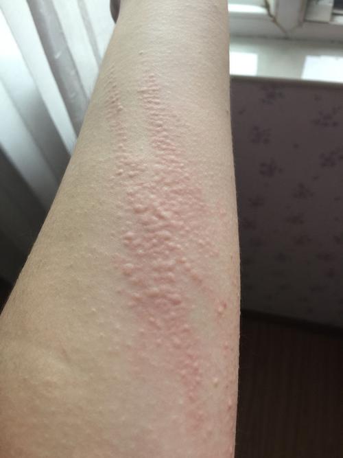 是荨麻疹吗?已经差不多三个月了,没