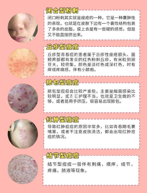 各种类型痘痘9595针对治疗!