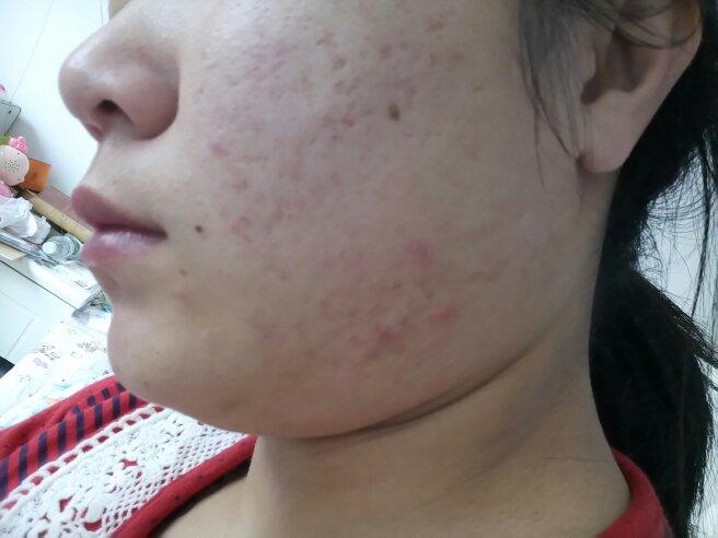 脸上有很多痘疤.谁有什么妙方.最好是自己用过且效果不错的.在线等