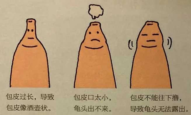 做包皮手术最佳年龄是多大