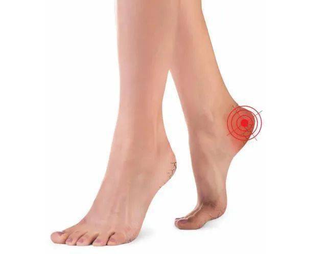 中医风湿病足跟痛不一定是痛风也可能是这些问题造成的
