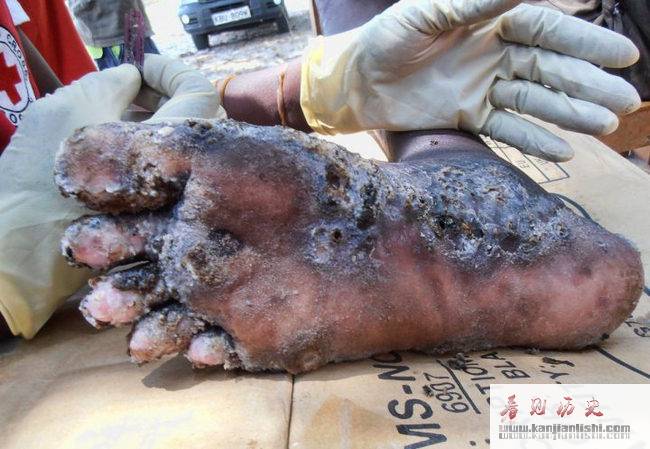 世界上十大最恶心的寄生虫