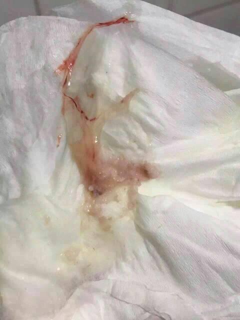 月经完了两天,又来了点白带加点血丝去医检查了tct