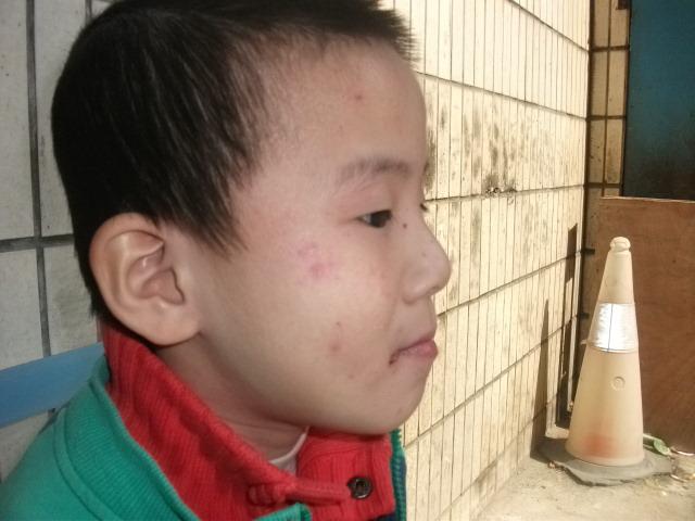 特应性皮炎能治愈吗