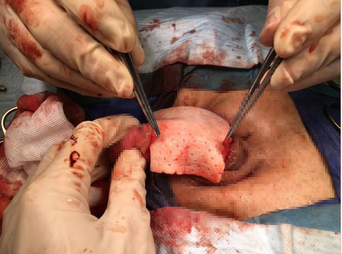 讲解:阴茎延长 增粗手术