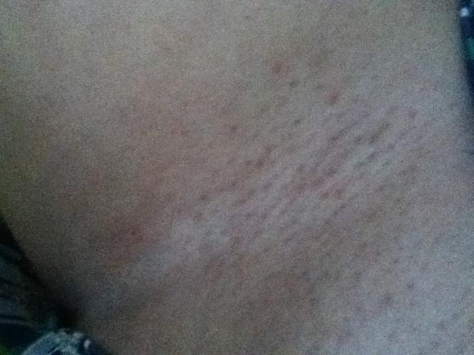 大腿根的内侧有红色的小点点