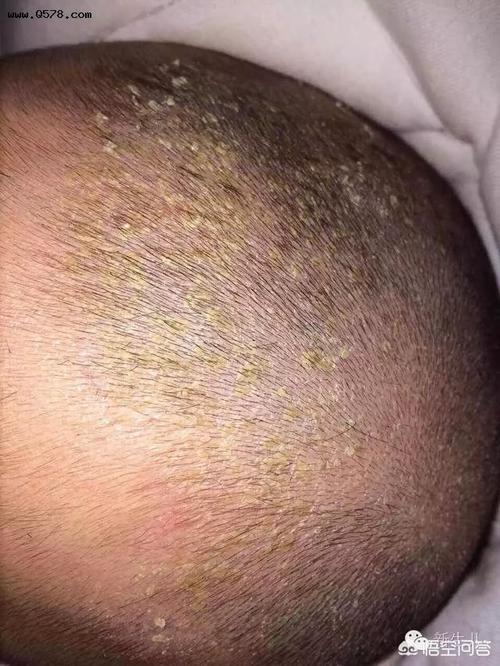 新生儿出生头上没有头垢,反而三个月后开始长头垢,这是怎么一回事?