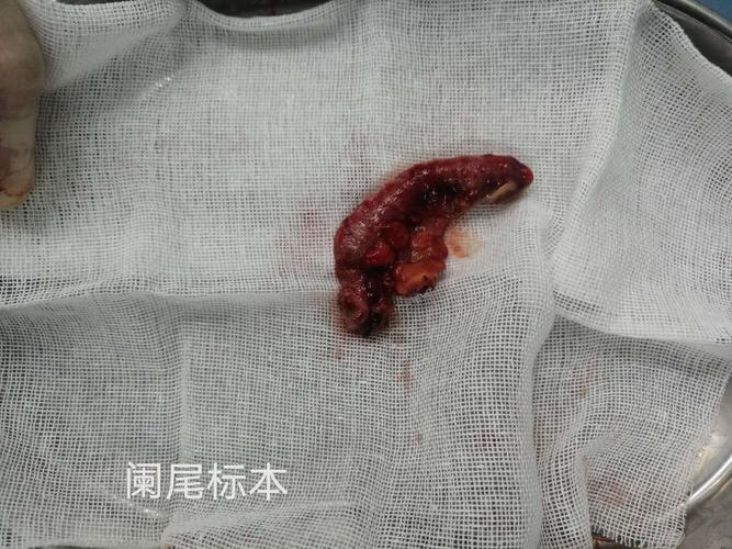 关注:忻州长江医院普外科 急性化脓性阑尾炎穿孔行腔镜阑尾切除术