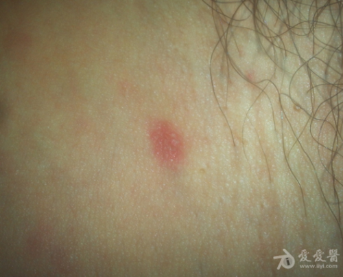 求助这是初期梅毒硬下疳吗