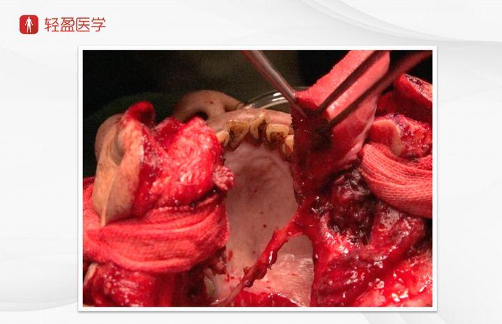 转移可能性大 【入院诊断】 扁桃体癌(右) 慢性咽喉炎 【手术方式】