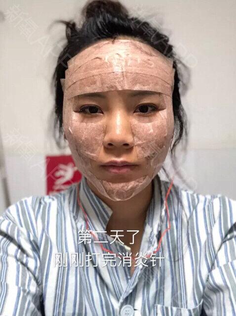 术后第1天     严重肿胀期               自体脂肪填充 我是填充的全