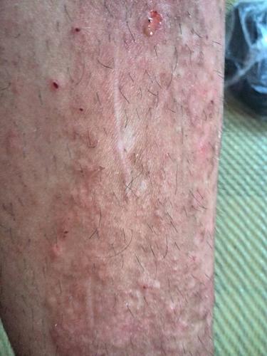 腿上起了东西,好几年了,麻烦帮我看看到底是皮炎还是热毒,该怎么治疗.