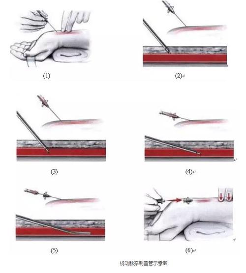 动脉穿刺置管首选桡动脉,常采用左侧(如左手功能占优势,则采用