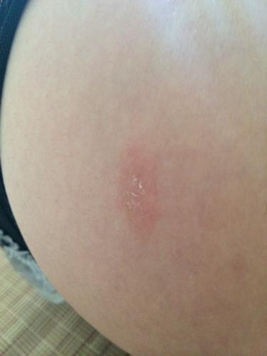 身上突然发现长了块这样的东西,不疼不痒,请问这是什么东西?