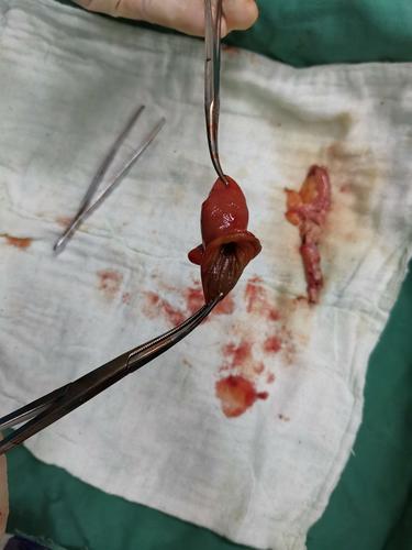 症状不典型的阑尾炎,术中发现美克尔毛憩室