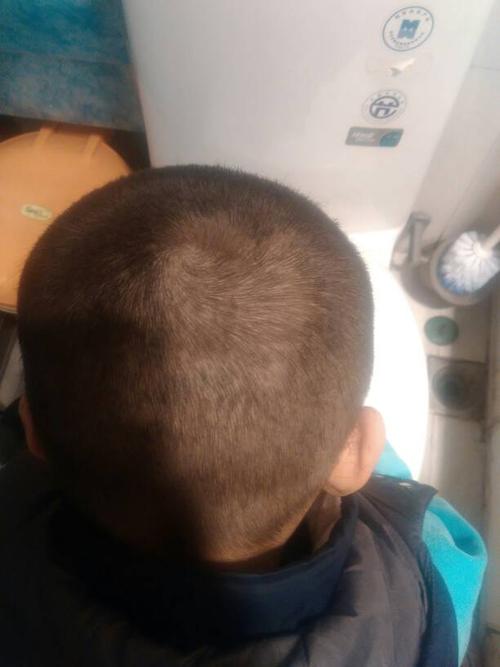我家小孩今年五岁,从1岁开始,头上有块头发一直是偏白,剪过以后想出来