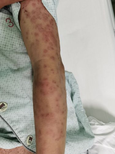 系统性红斑狼疮皮疹