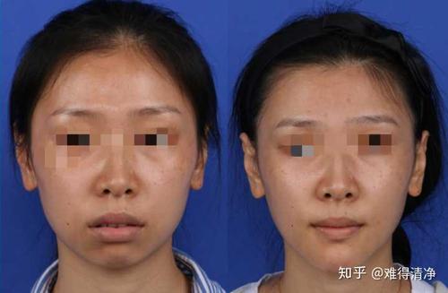 颏部(下巴)畸形 颏部骨骼前后向发育不足或过度引起的下