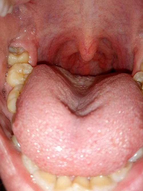 喉咙里有小肉疙瘩,嗓子干涩发痒,但是不痛,时不时的咳嗽,每天早上