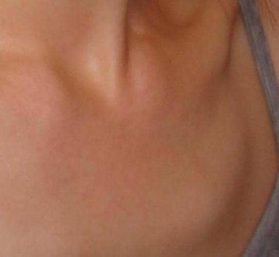 锁骨骨折畸形愈合图片