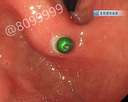 曲靖8岁男童胃穿孔三次入院!医生竟在他肚子里发现了21颗