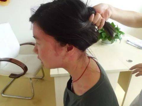 过敏体质者 如果有海产品过敏的症状,千万别吃小龙虾.